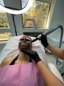 Hollywood peel