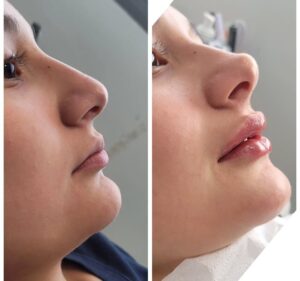 Aumento de labios