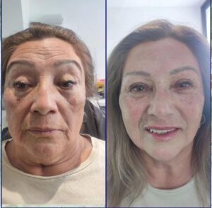 Armonización facial